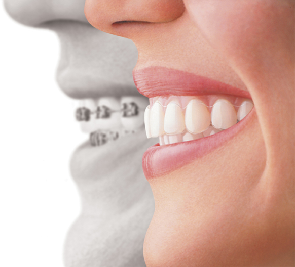 Advantages of Invisalign in Queens, NY