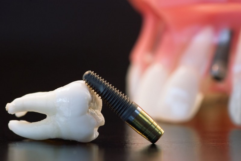 Why You Need Implant Dentistry Services In Rockville, MD