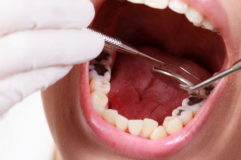 Sedation Dentistry: Definition, Types and Reasons