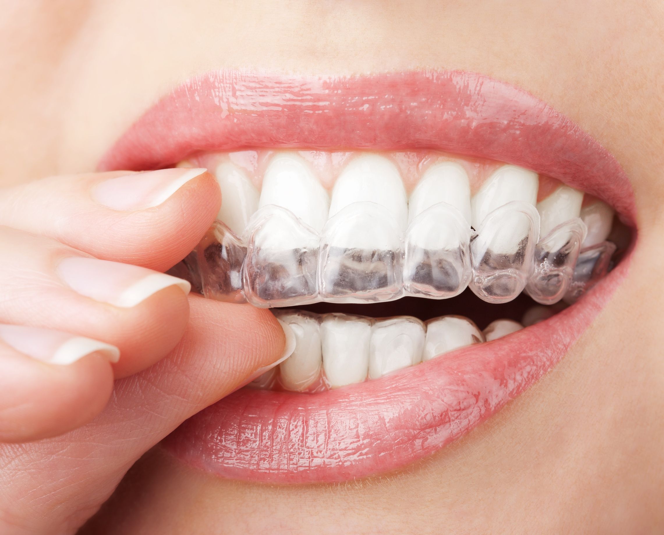 What Should Individuals Know About Invisalign in Fort Myers, Florida?