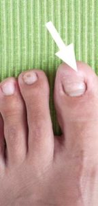 Getting Rid of an Ingrown Toenail While Living in Phoenix, Arizona