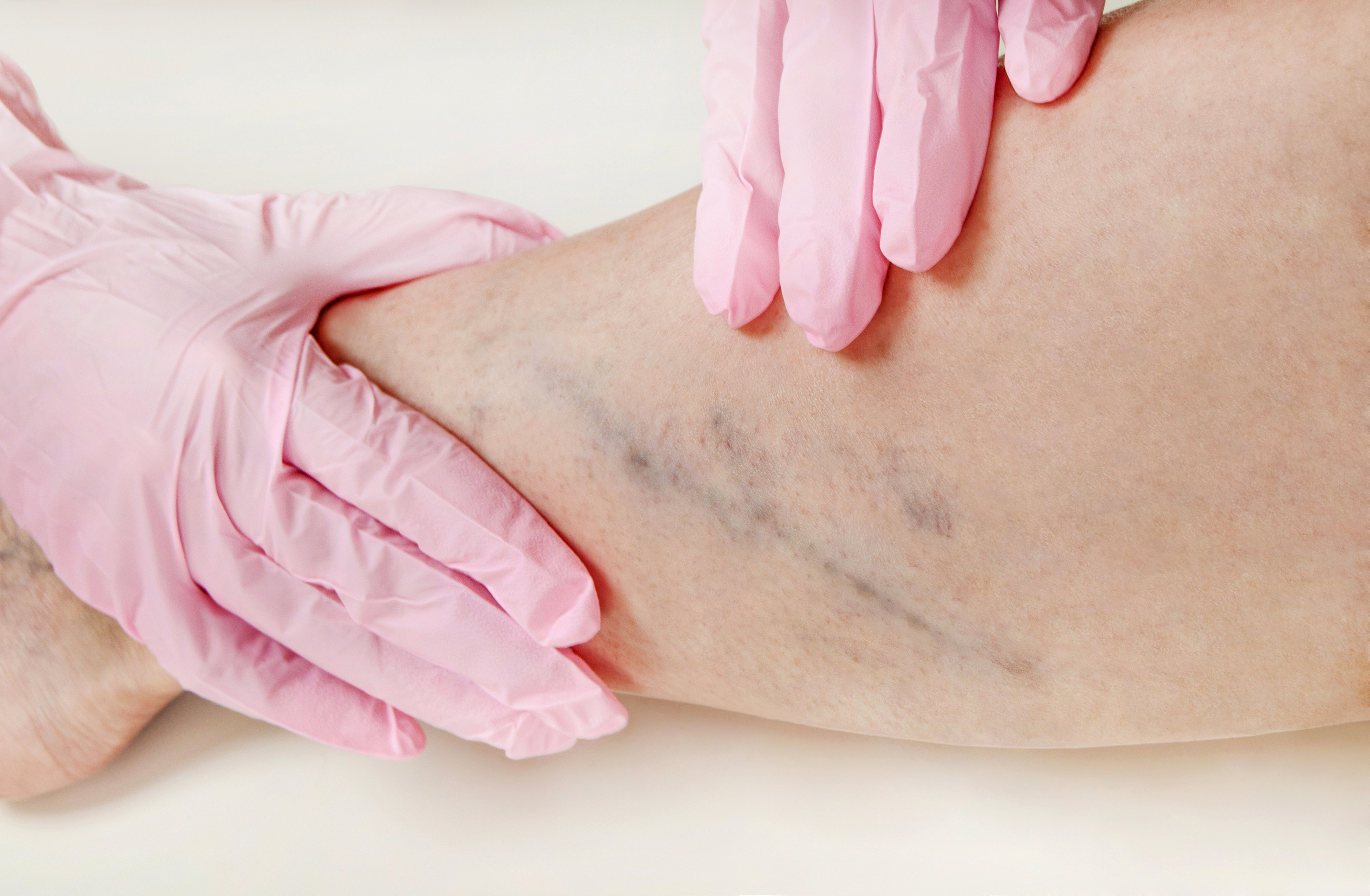 A Center for Vein Restoration in Hamilton, NJ, Revitalizes Circulation