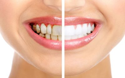 Personalized Perfection: Achieve Your Dream Smile With Dental Veneers in Dayton, OH