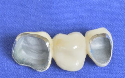 Dental Crown In Kennewick Solutions: Repair, Restore, And Improve Your Smile With Confidence