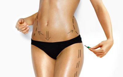 Achieve Natural Curves With Radiesse Buttock Injections in Cancun, MX: A Guide to Transformative Beauty